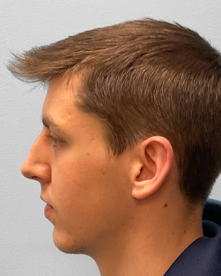 Before Image: Rhinoplasty – Dr. Tucker - left-side