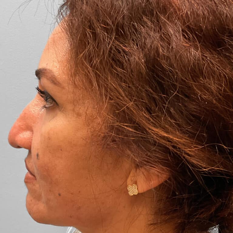 Before Image: Rhinoplasty – Dr. Tucker - left-side