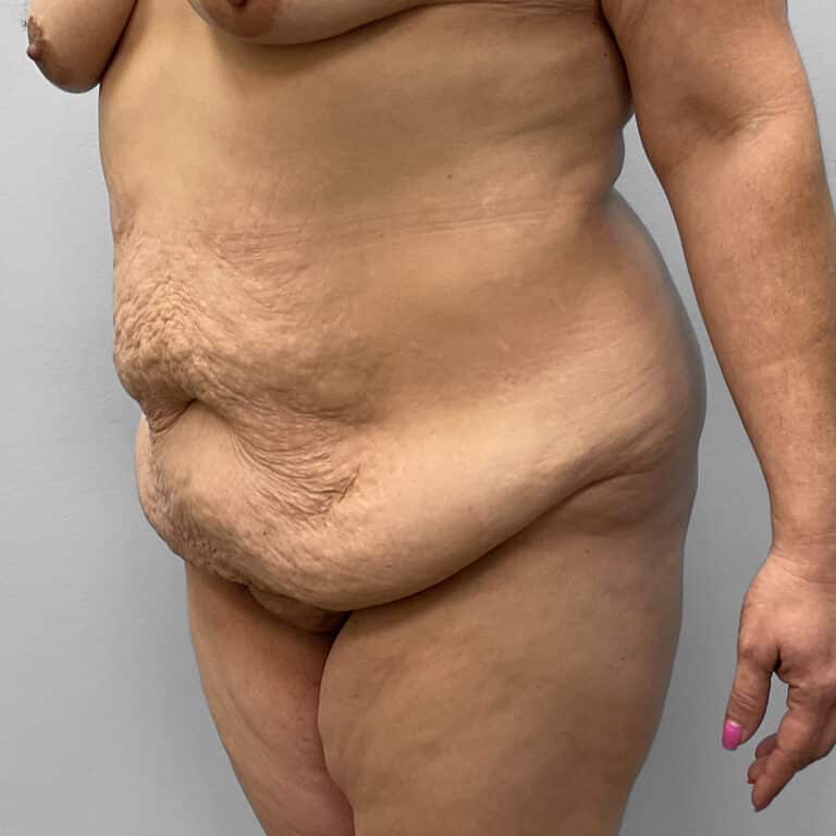 Before Image: Tummy Tuck – Dr. Howell - left-front-oblique