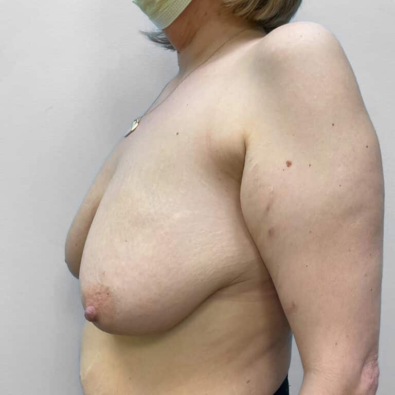 Before Image: Breast Reduction- Dr. Howell - left-front-oblique