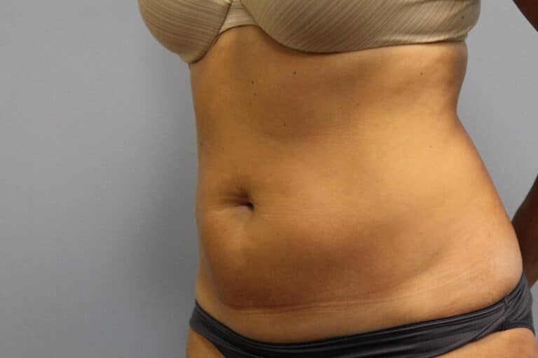 Before Image: Smart Lipo – Dr. Tucker - left-front-oblique