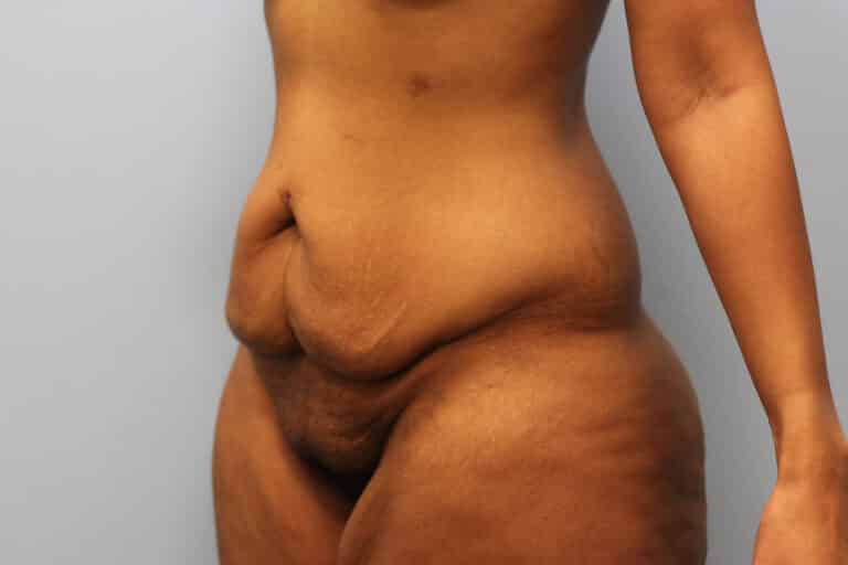 Before Image: Mommy Makeover- Dr. Howell - left-front-oblique