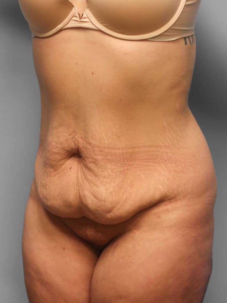 Before Image: Abdominoplasty – Dr. Howell - left-front-oblique