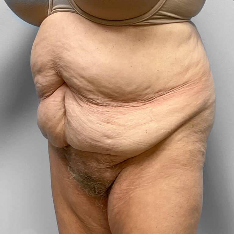 Before Image: Abdominoplasty – Dr. Howell - left-front-oblique