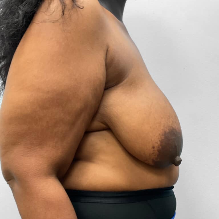 Before Image: Breast & Arm Lift with Liposuction – Dr. Howell - right-side