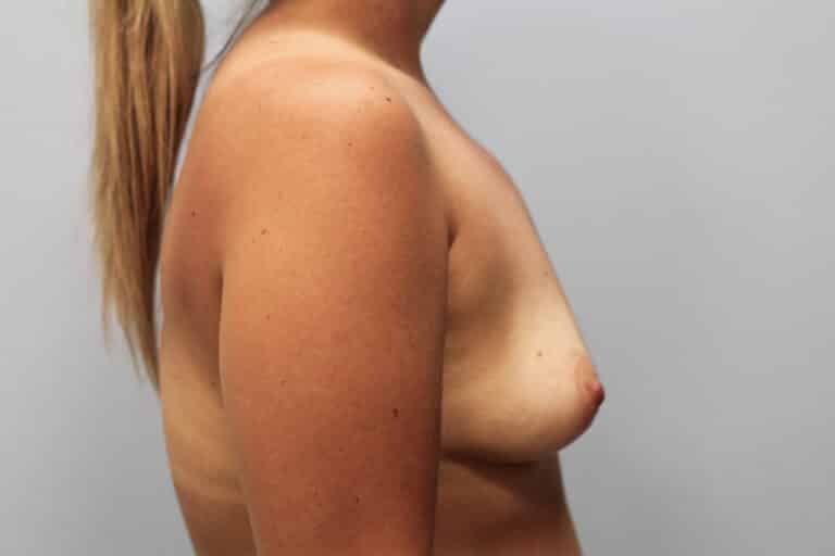 Before Image: Breast Augmentation – Dr. Tucker - right-side