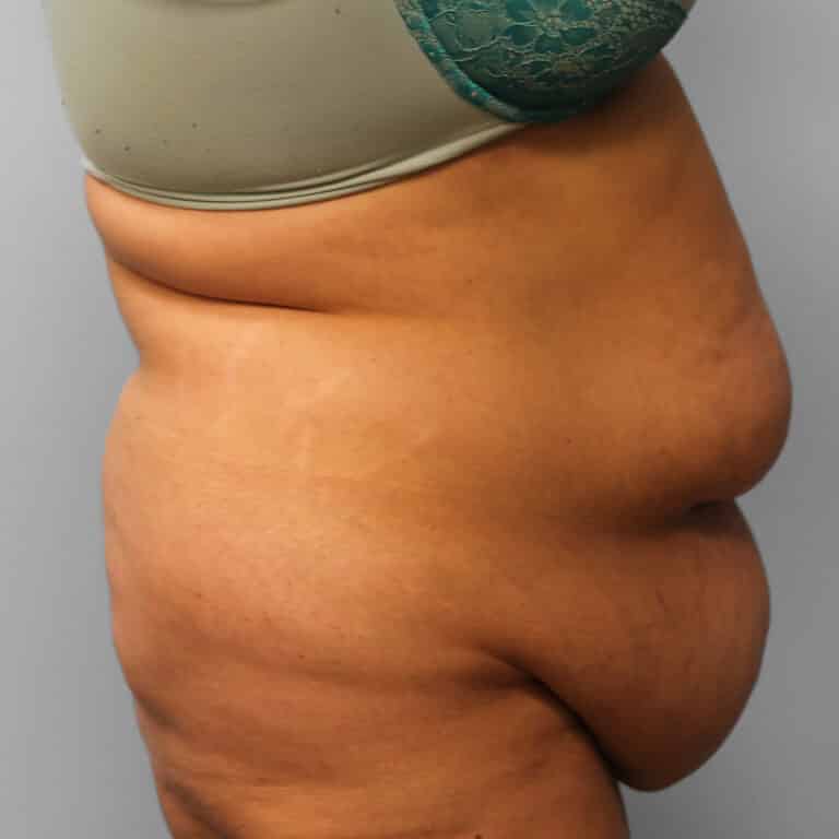 Before Image: Abdominoplasty & Lipo – Dr. Howell - right-side