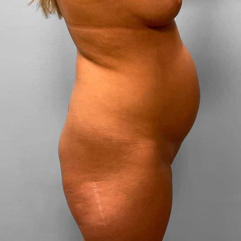 Before Image: Mommy Makeover – Dr. Tucker - right-side