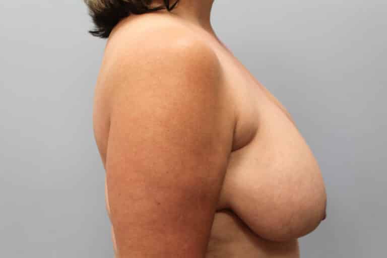 Before Image: Breast Reduction, Tummy Tuck & Lipo- Dr.Howell - right-side