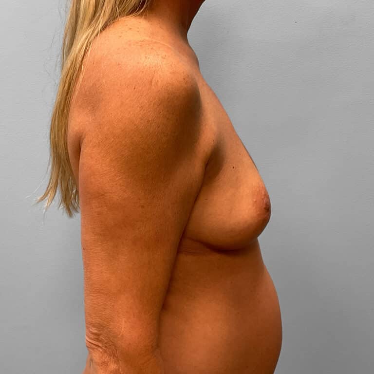 Before Image: Mommy Makeover – Dr. Tucker - right-side