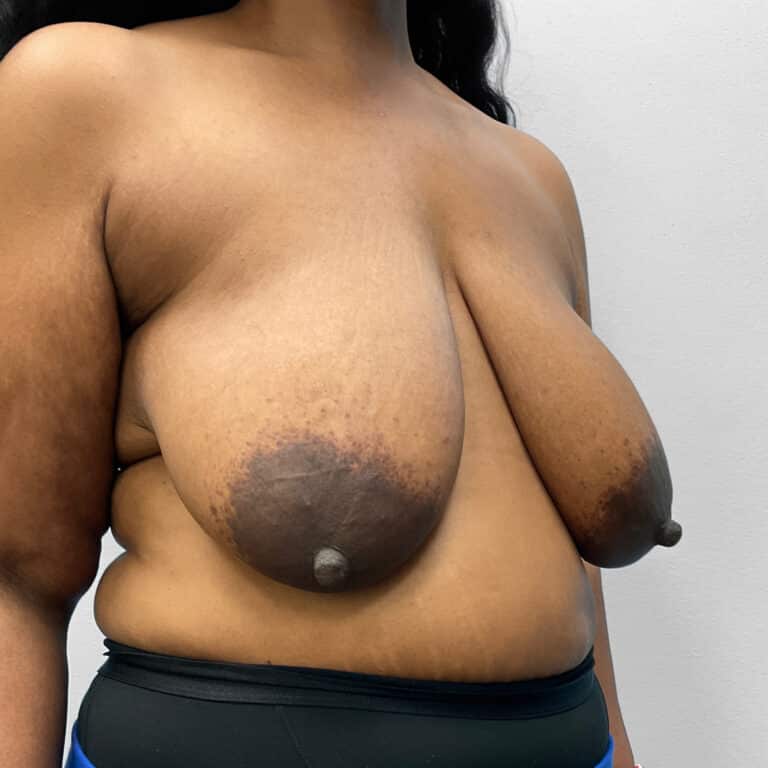 Before Image: Breast & Arm Lift with Liposuction – Dr. Howell - right-front-oblique