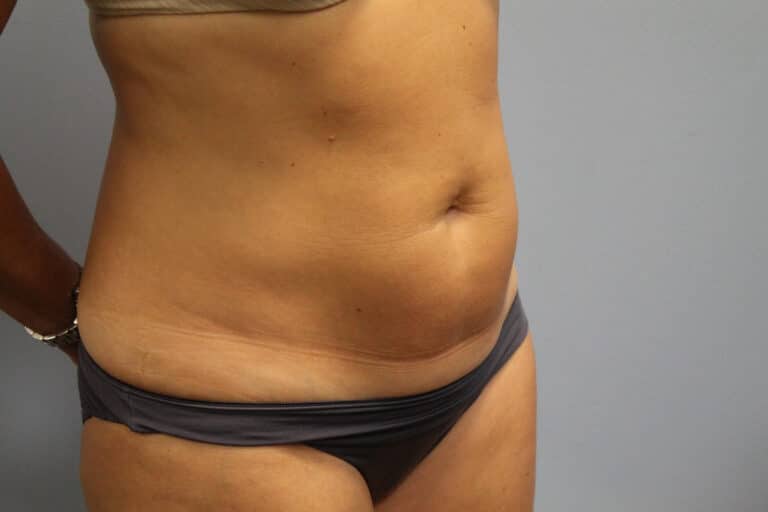 Before Image: Smart Lipo – Dr. Tucker - right-front-oblique