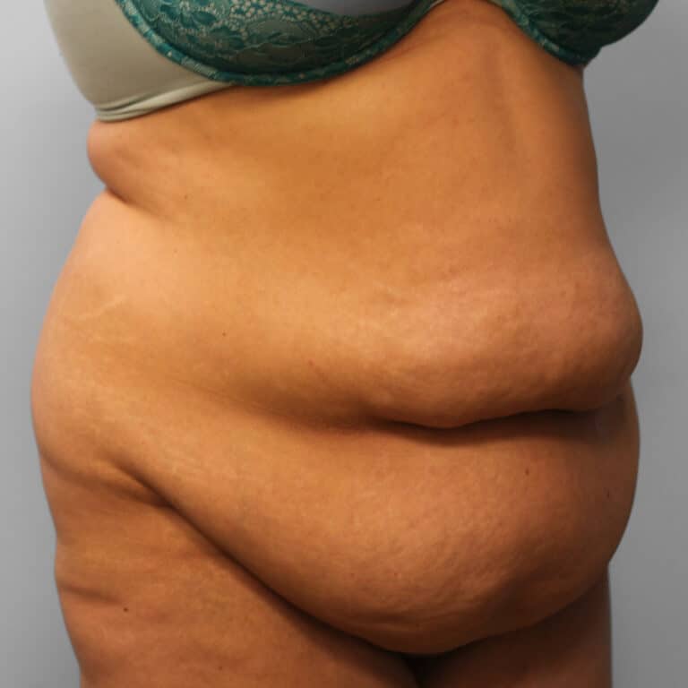 Before Image: Abdominoplasty & Lipo – Dr. Howell - right-front-oblique