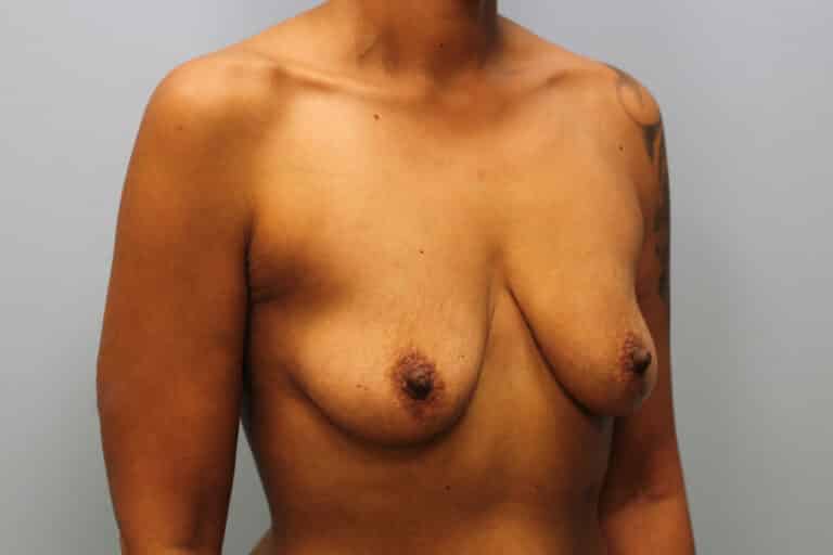Before Image: Mommy Makeover- Dr. Howell - right-front-oblique