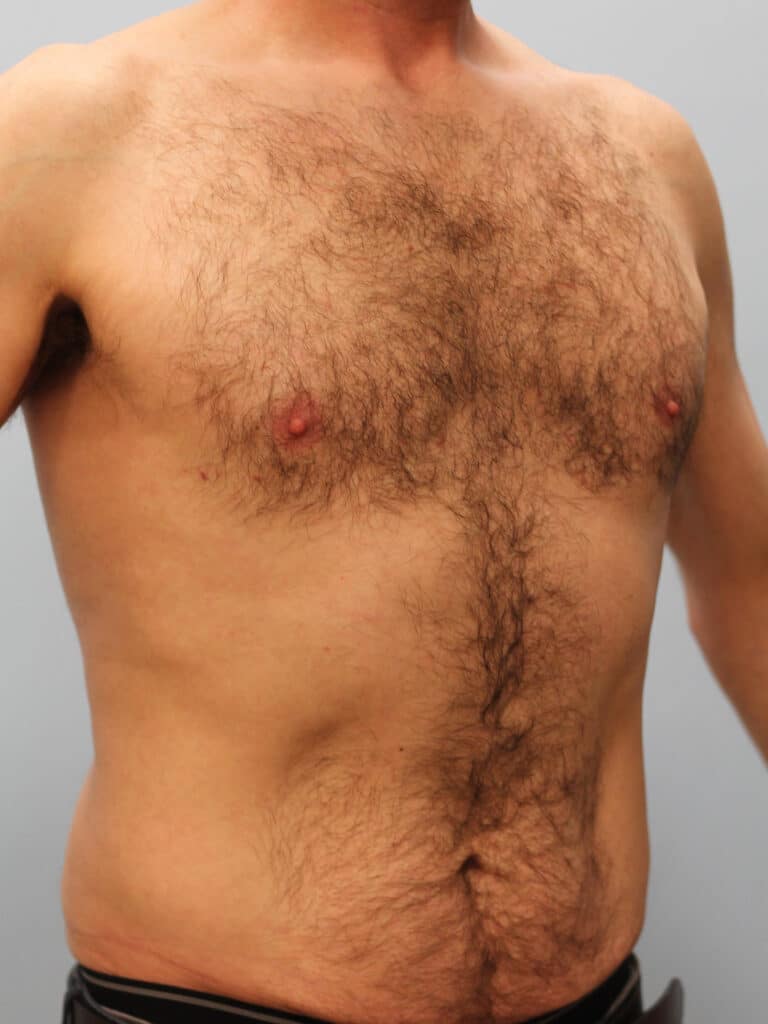 Before Image: Gynecomastia & Lipo-Dr. Howell - right-front-oblique