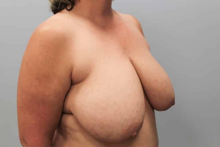 Before Image: Breast Reduction, Tummy Tuck & Lipo- Dr.Howell - right-front-oblique