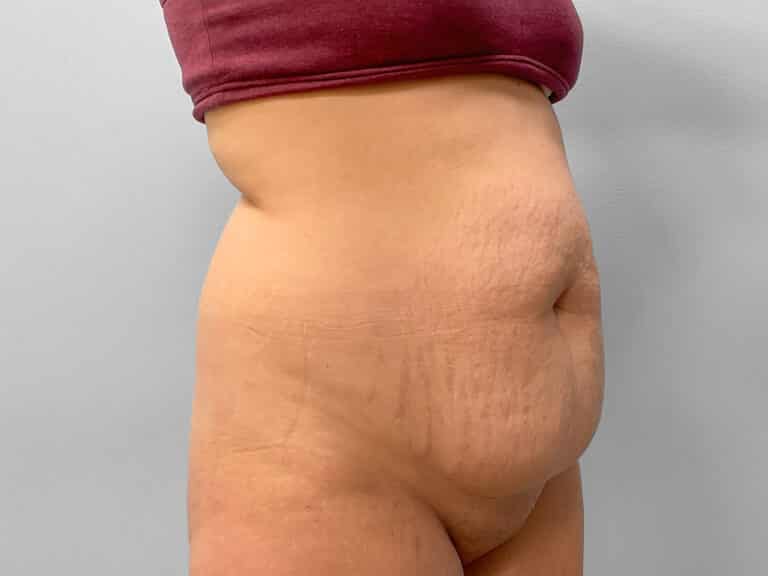 Before Image: Abdominoplasty & Liposuction – Dr. Howell - right-front-oblique