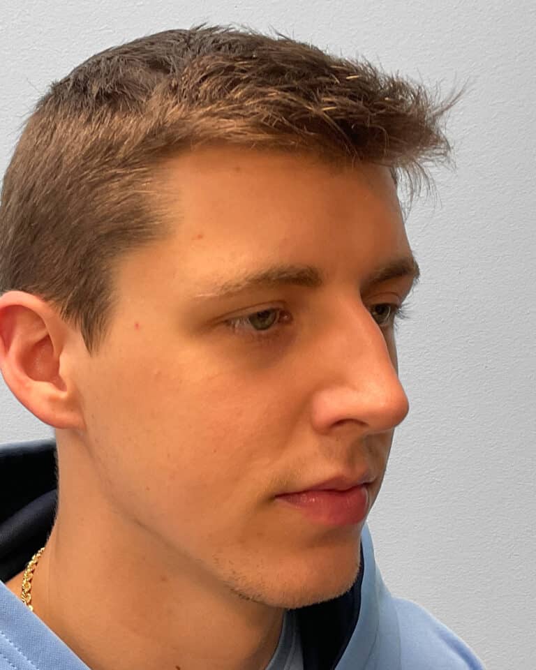 Before Image: Rhinoplasty – Dr. Tucker - right-front-oblique