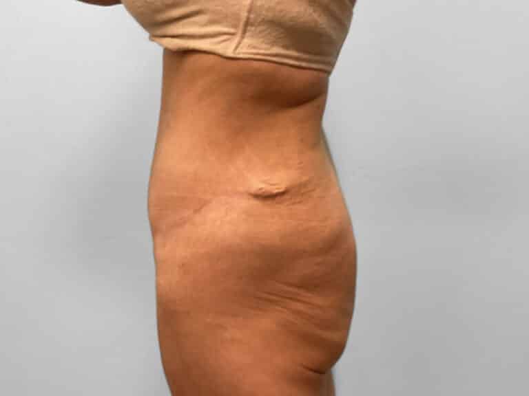 Before Image: Body Lift – Dr. Howell - left-side