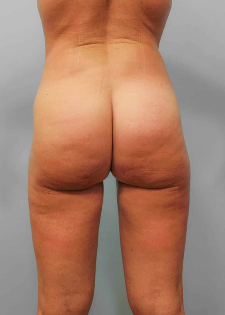 After Image: SmartLipo- Dr. Howell - back