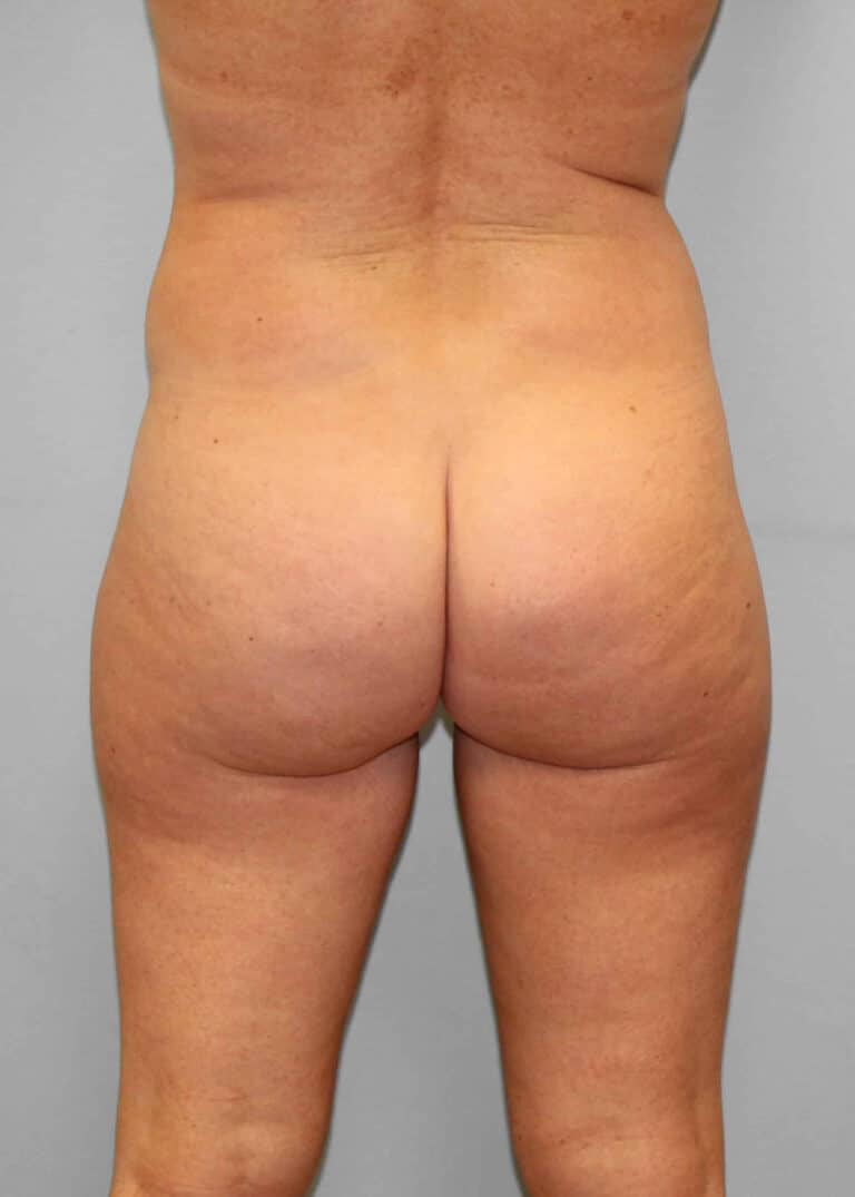 Before Image: SmartLipo- Dr. Howell - back