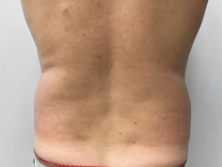 Before Image: Liposuction – Dr. Tucker - front