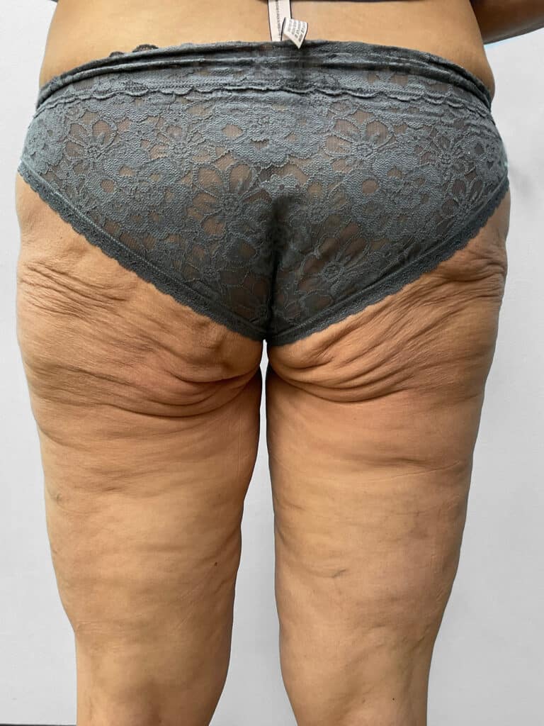 Before Image: Thigh Liposuction – Dr. Howell - back
