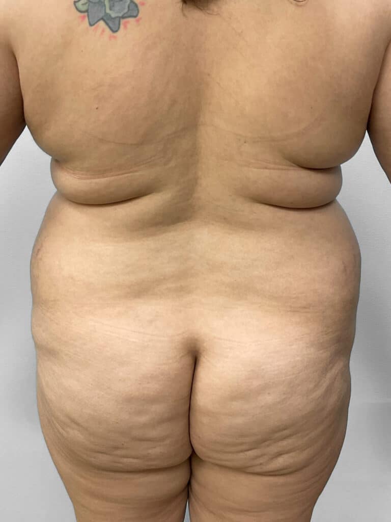 Before Image: Tummy Tuck, Lipo, & BBL – Dr. Tucker - back