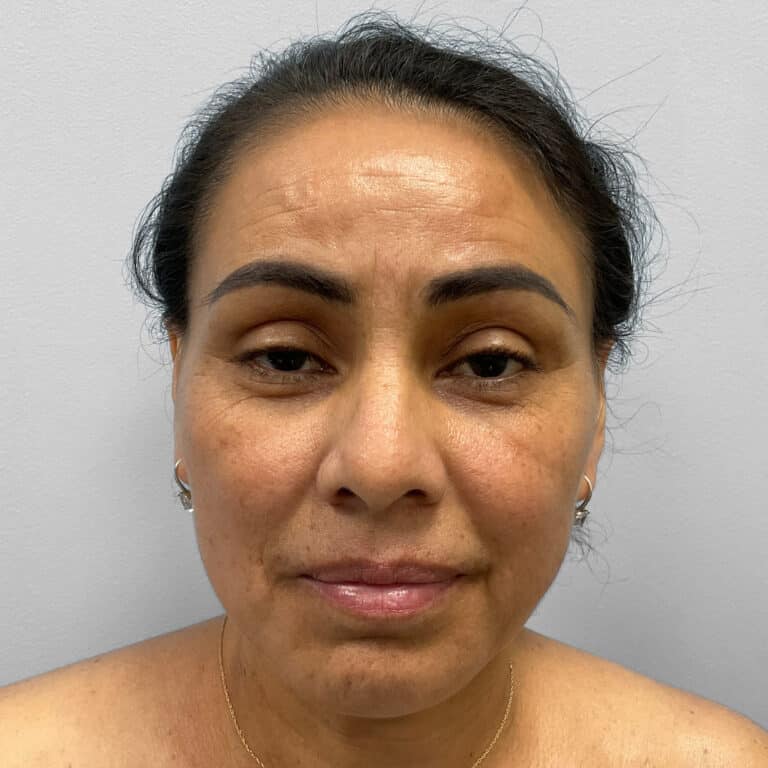 Before Image: Upper and Lower Blepharoplasty – Dr. Tucker - front