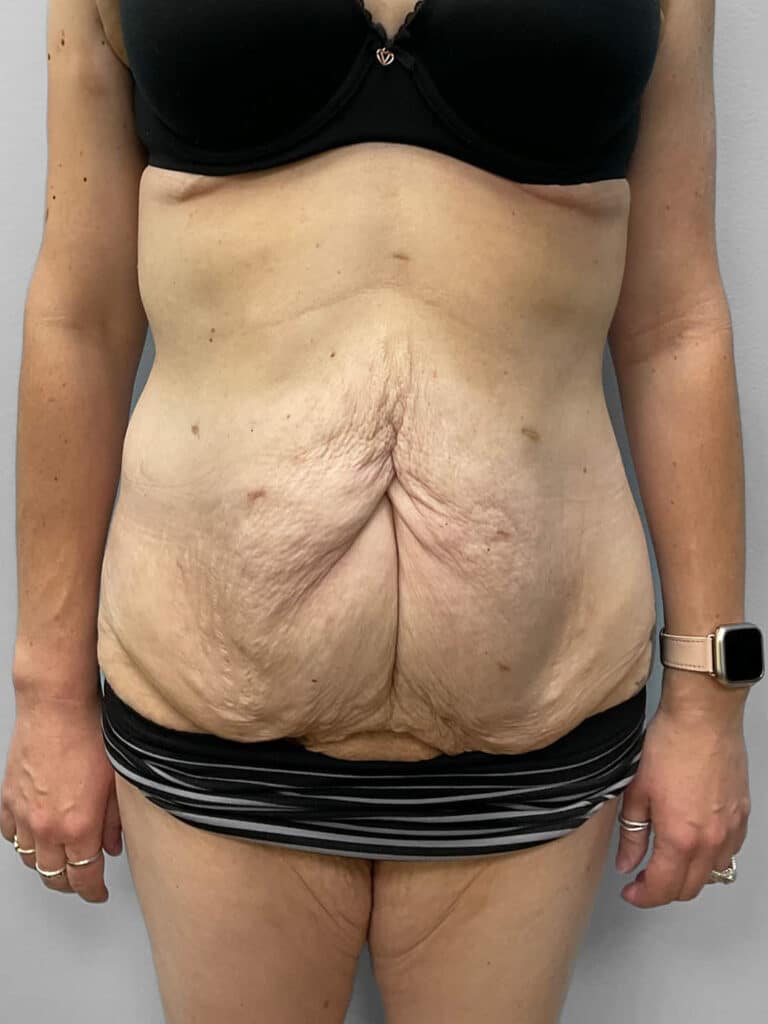 Before Image: Abdominoplasty & Liposuction – Dr. Howell - front