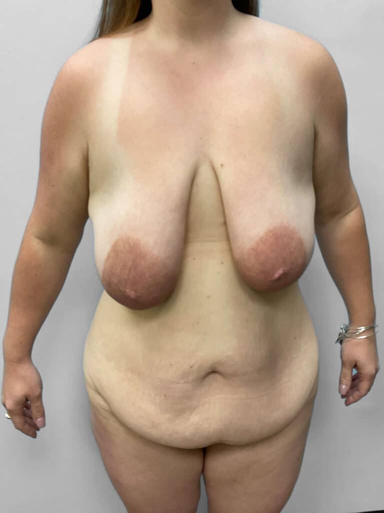 Before Image: Mommy Makeover- Dr. Howell - front