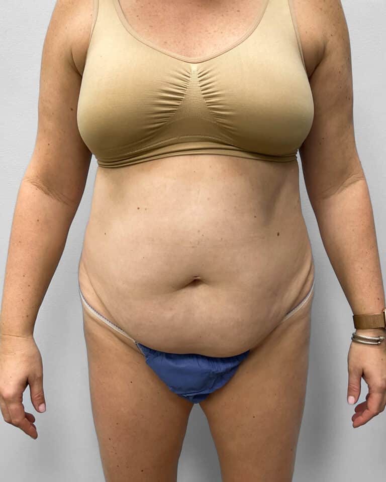 Before Image: Abdominoplasty & Liposuction – Dr. Tucker - front