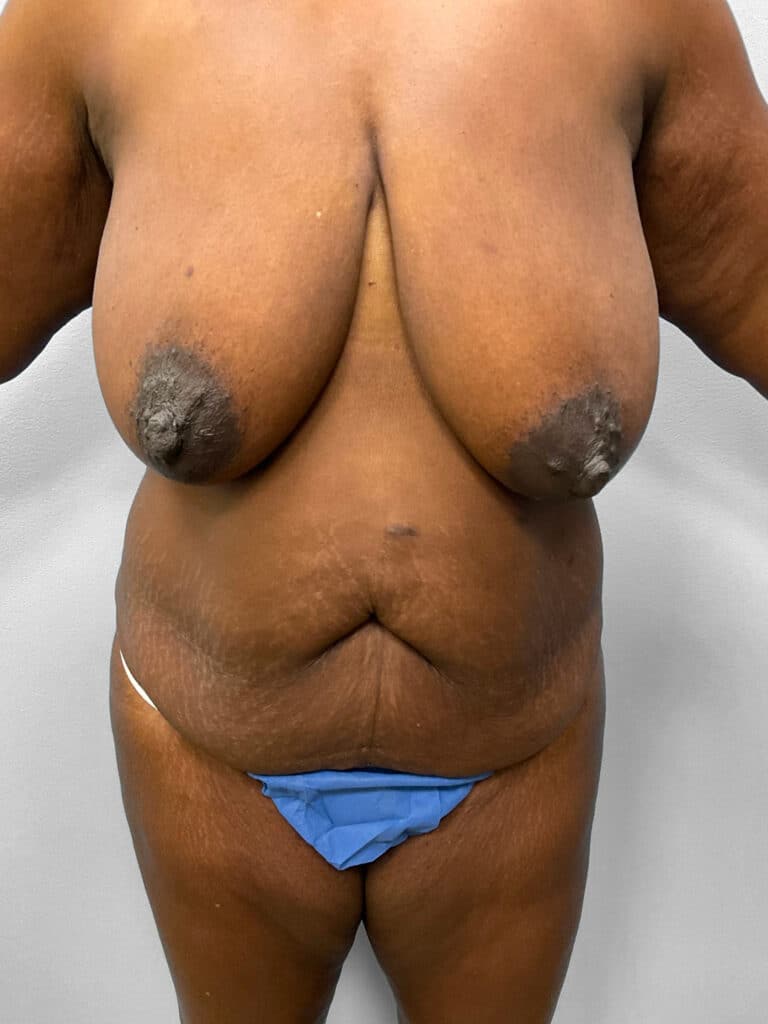 Before Image: Mommy Makeover – Dr. Tucker - front