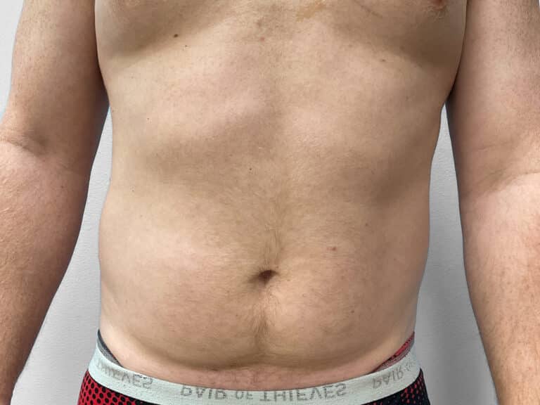 Before Image: Liposuction – Dr. Tucker - front