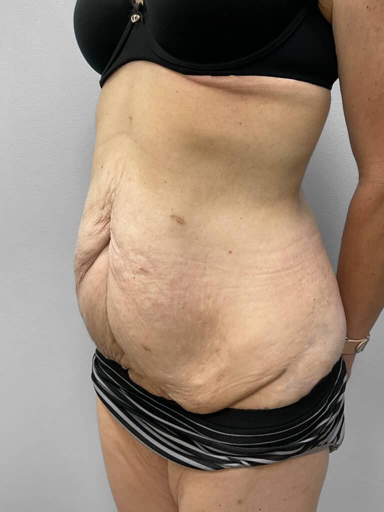 Before Image: Abdominoplasty & Liposuction – Dr. Howell - left-front-oblique