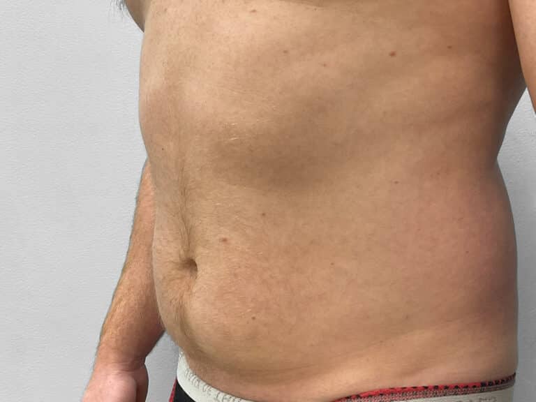Before Image: Liposuction – Dr. Tucker - left-front-oblique