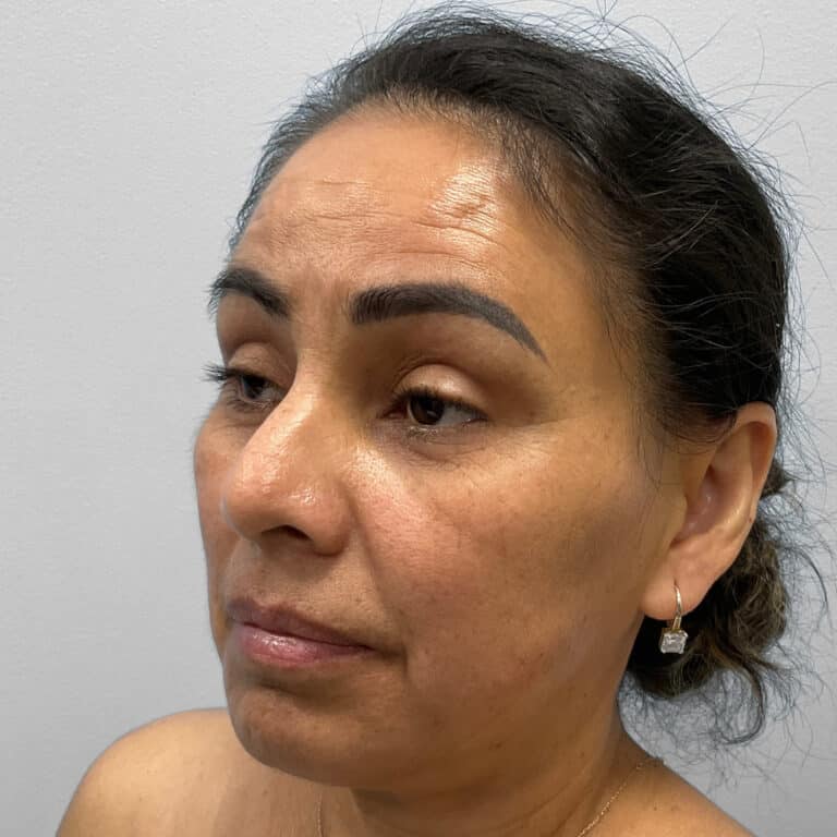 Before Image: Upper and Lower Blepharoplasty – Dr. Tucker - left-front-oblique