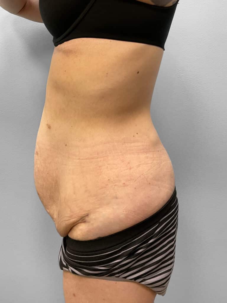 Before Image: Abdominoplasty & Liposuction – Dr. Howell - left-side