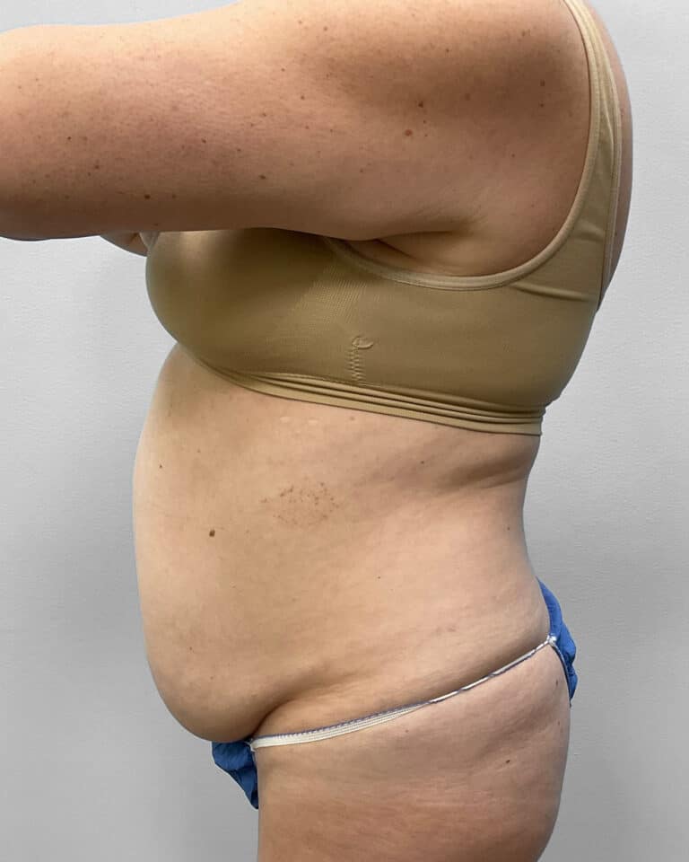 Before Image: Abdominoplasty & Liposuction – Dr. Tucker - left-side