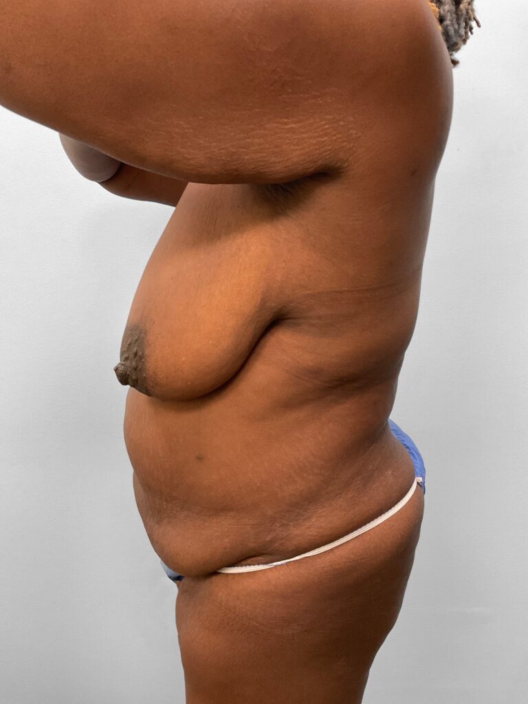 Before Image: Mommy Makeover – Dr. Tucker - left-side