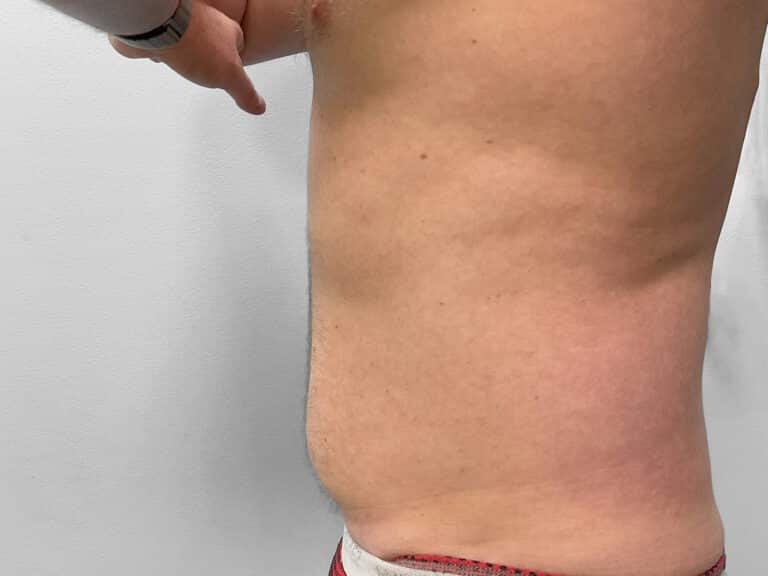 Before Image: Liposuction – Dr. Tucker - left-side