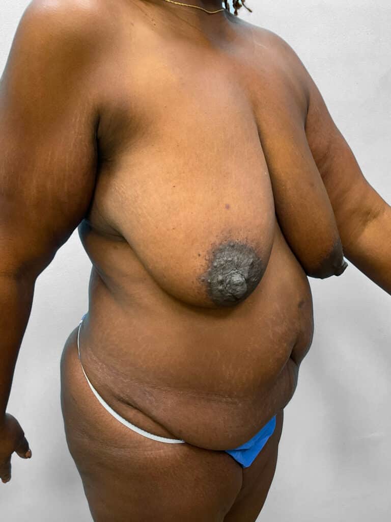 Before Image: Mommy Makeover – Dr. Tucker - right-front-oblique