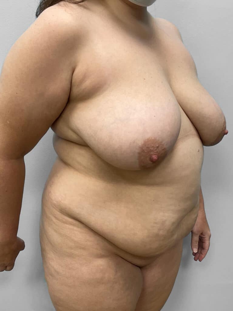 Before Image: Tummy Tuck, Lipo, & BBL – Dr. Tucker - right-front-oblique