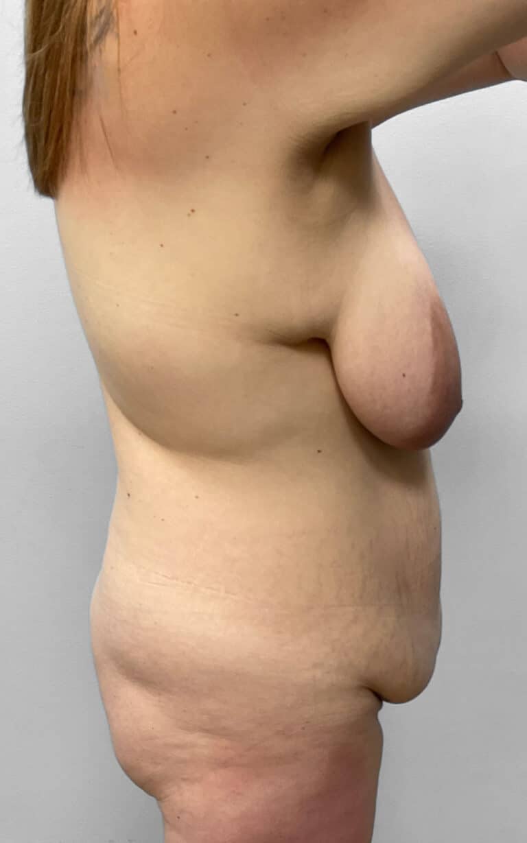 Before Image: Mommy Makeover- Dr. Howell - right-side