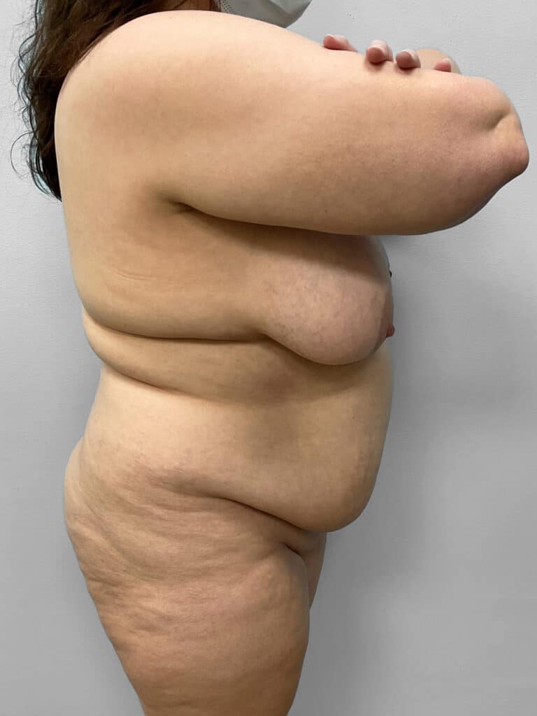Before Image: Tummy Tuck, Lipo, & BBL – Dr. Tucker - right-side