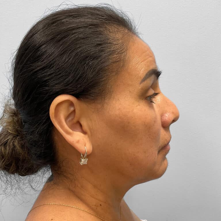 Before Image: Upper and Lower Blepharoplasty – Dr. Tucker - right-side