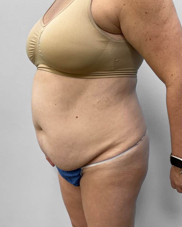 Before Image: Abdominoplasty & Liposuction – Dr. Tucker - left-front-oblique