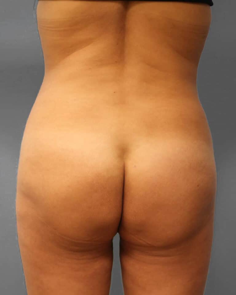 After Image: Lipo & BBL- Dr. Howell - back