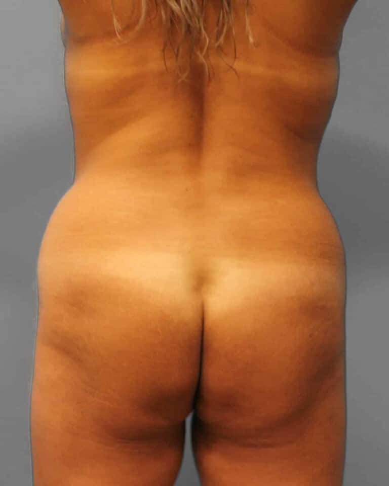 Before Image: Lipo & BBL- Dr. Howell - back