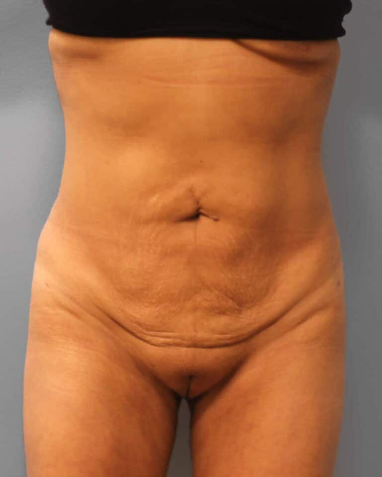 After Image: Lipo & BBL- Dr. Howell - front
